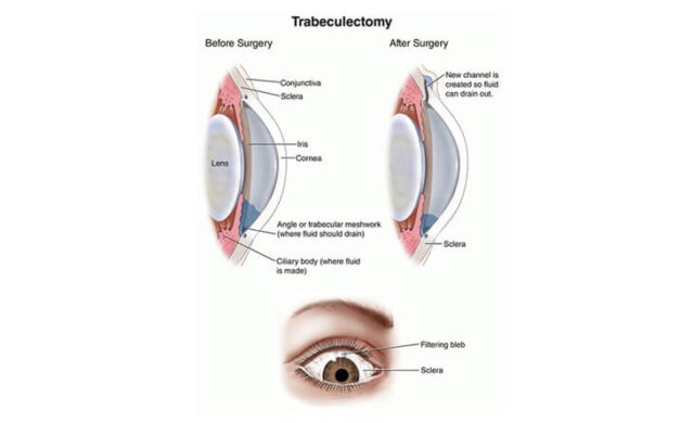 Glaucoma Surgery in Delhi | Best Eye Doctor in Delhi