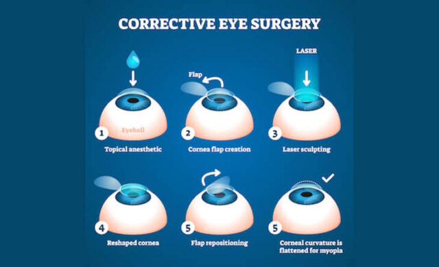 What is Refractive or Lasik Surgery?