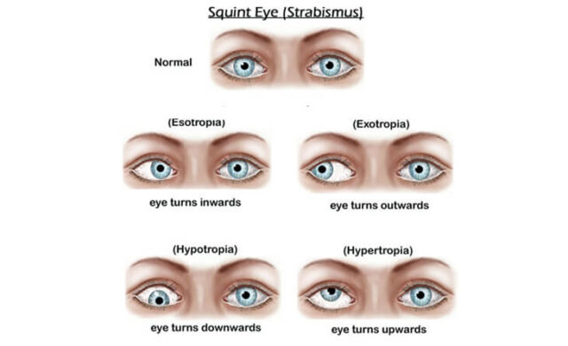 Squint Eye Surgery: Types, Causes, Treatment and Cost