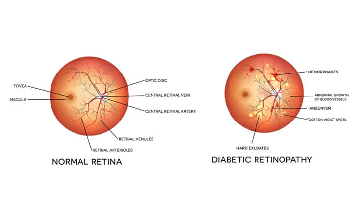 Eye Test for Diabetes Patients