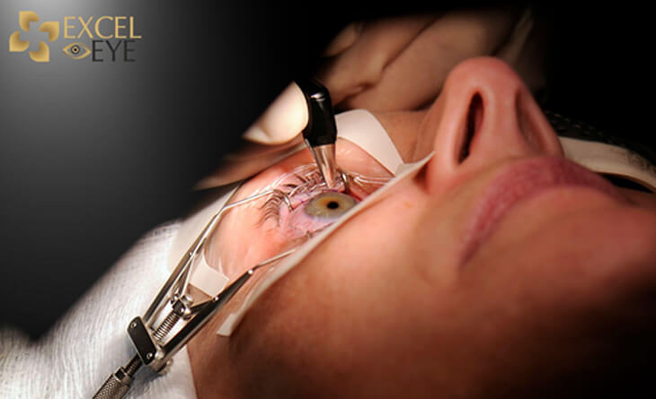 Lasik Surgery