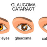 Glaucoma Surgery