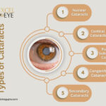 Cataract Surgery