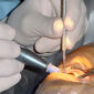 cataract surgery