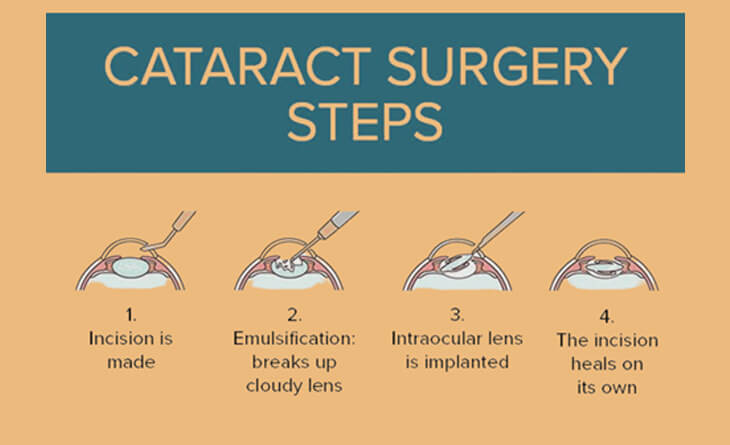 cataract surgery