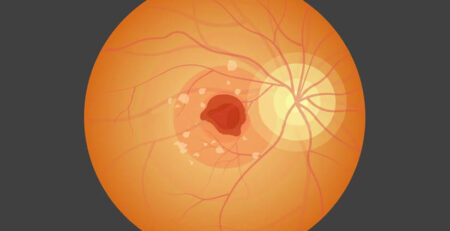 macular degeneration treatment