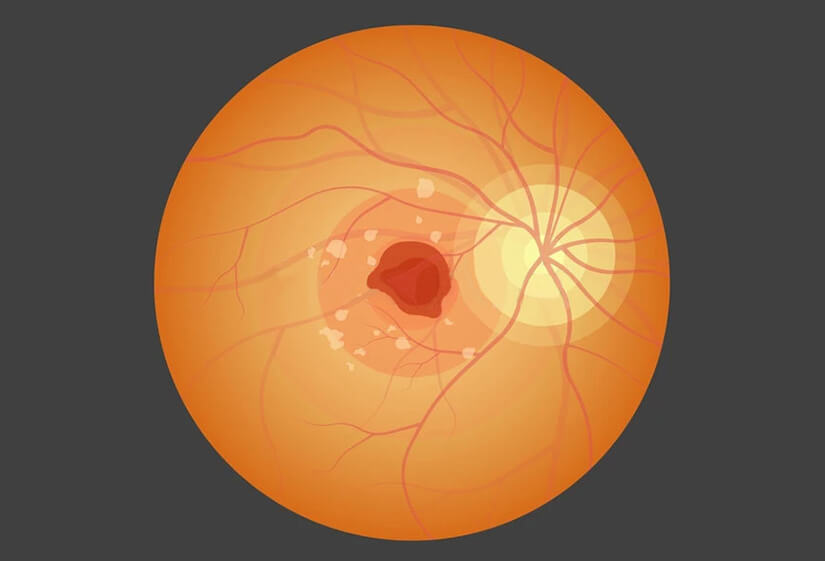 macular degeneration treatment