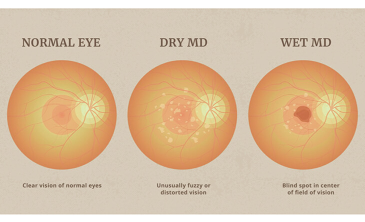 macular degeneration treatment