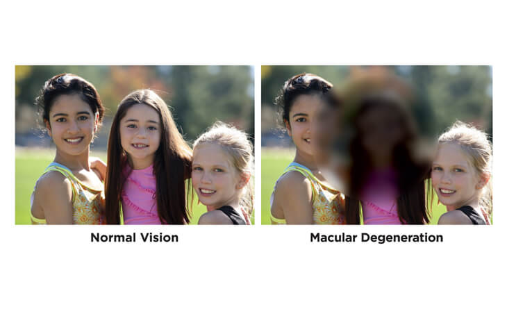 macular degeneration treatment