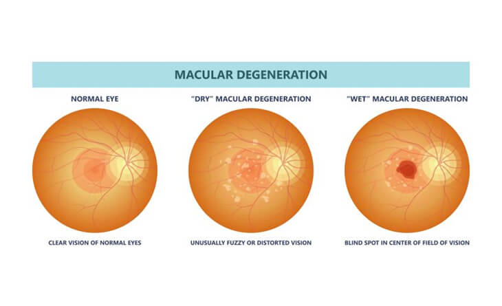 macular degeneration treatment