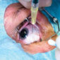 retinal haemorrhage treatment