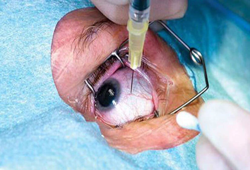 retinal haemorrhage treatment