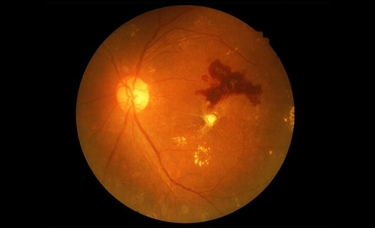 retinal haemorrhage treatment