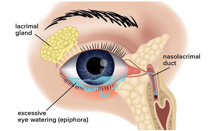 Watery Eye Causes