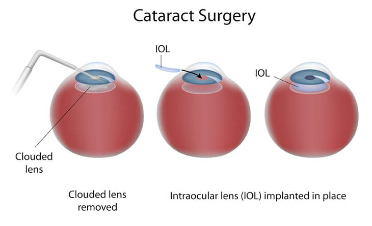 Average Age for Cataract Surgery