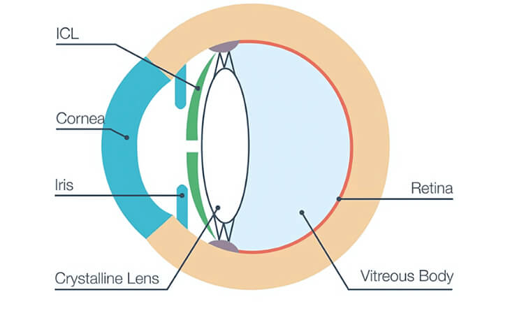 Implantable Contact Lenses - Dr Anisha Gupta - Eye Specialist in Delhi -02 Implantable Contact Lens