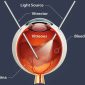retina surgery