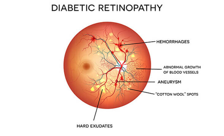 How To Prevent Eye Damage From Diabetes - Dr Anisha Gupta - Eye Specialist in Delhi -02 diabetic retinopathy